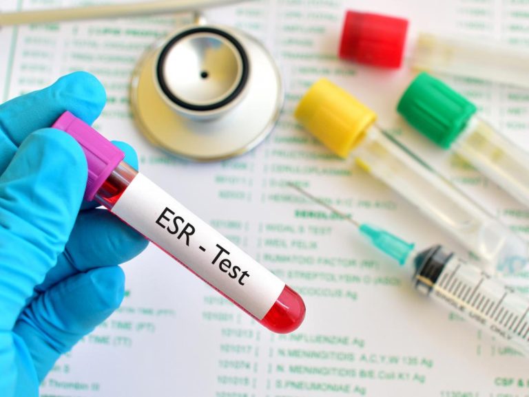 erythrocyte-sedimentation-rate-esr-purpose-procedure-lti