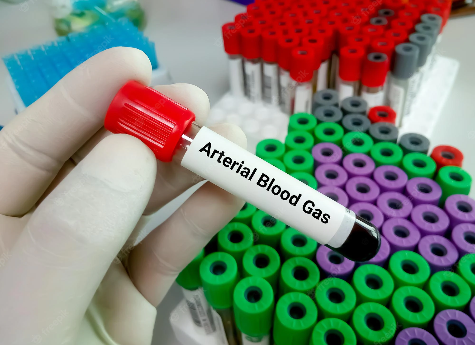 Arterial Blood Gas ABG
