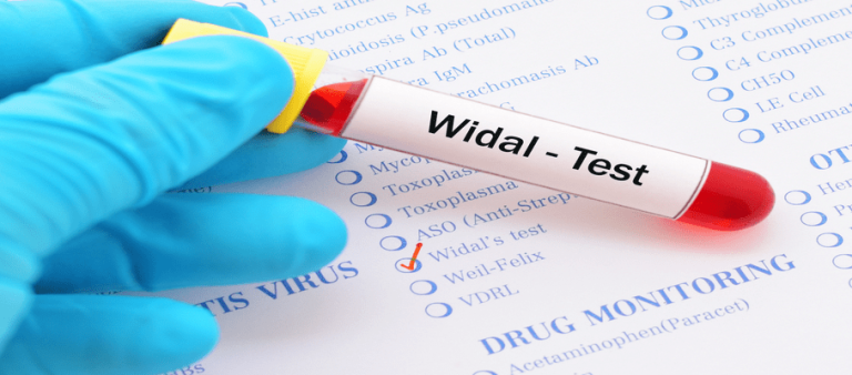 Widal Test