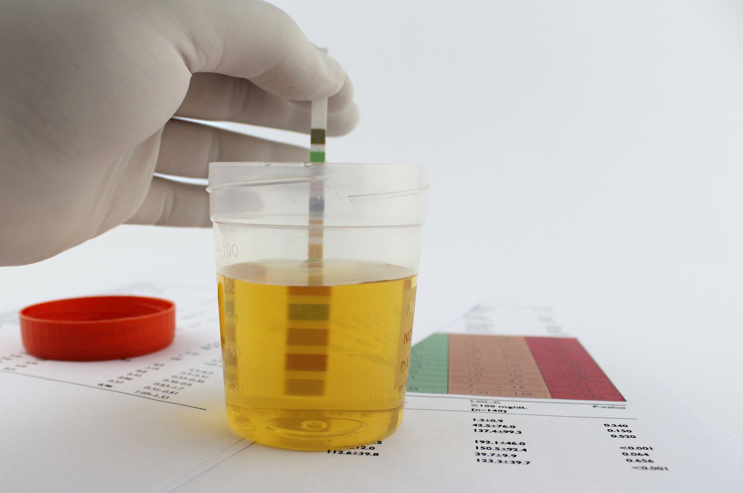 Urine Protein Purpose Procedure Results Risks And Lti 1639