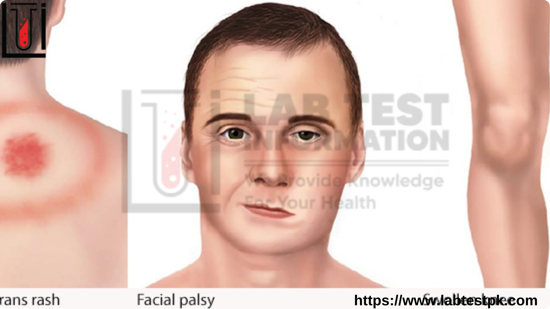 Lymph Disease