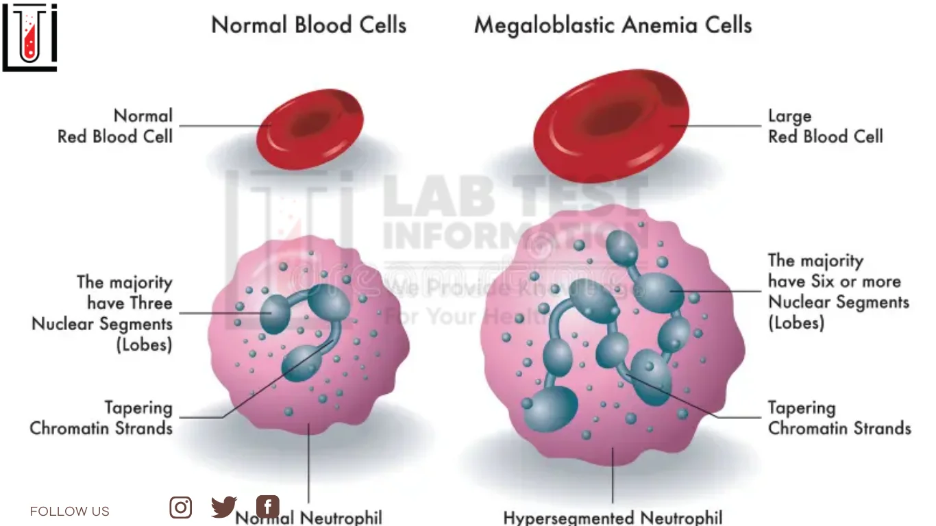 Megaloblastic Anemia